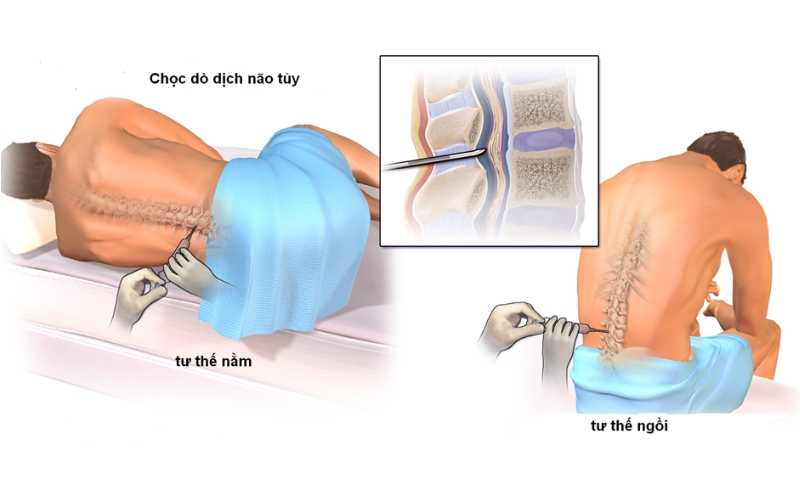 Xét nghiệm dịch não tủy là một thủ thuật xâm lấn, được thực hiện bằng cách chọc dò thắt lưng.